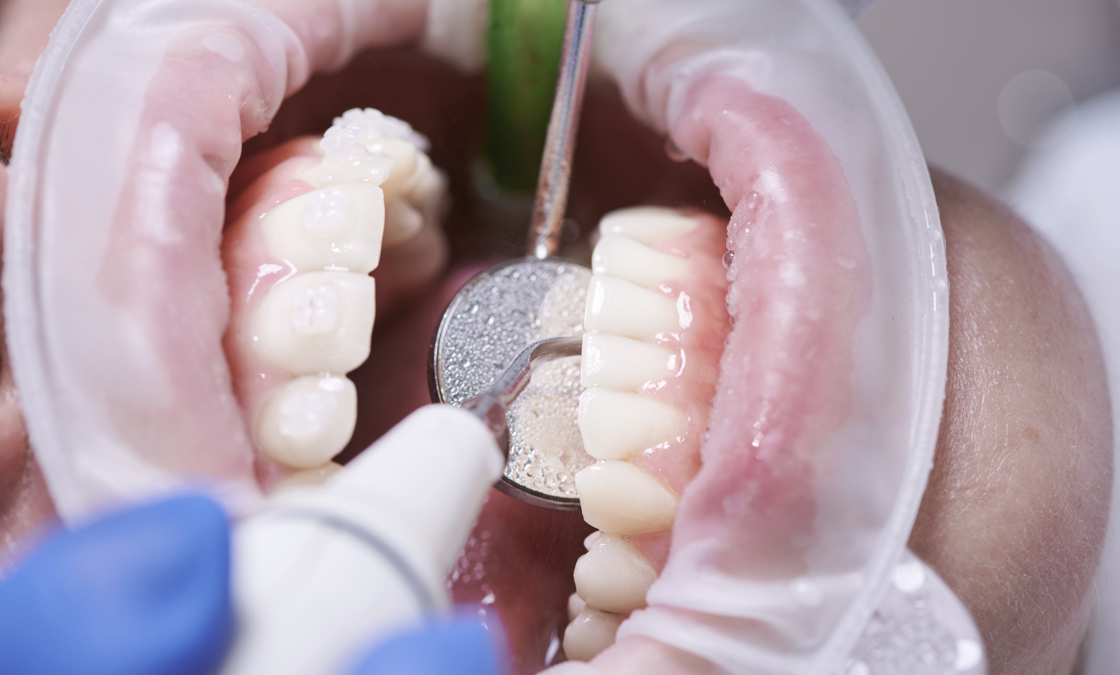 dental cleaning in La Marque, Texas
