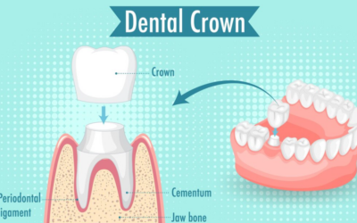 Key Factors That Affect the Lifespan of Your Dental Crown